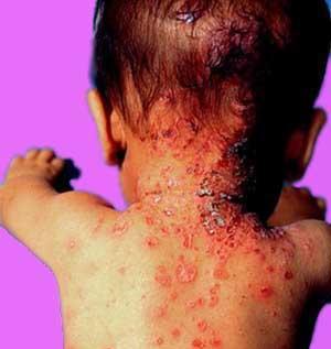 对儿童泛发性脓疱性银屑病的护理是什么