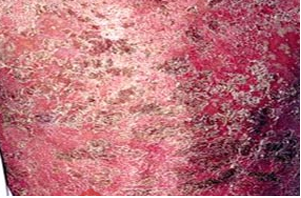 红皮型牛皮癣具有哪些临床表现