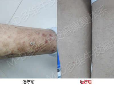 患有银屑病的辩证治疗怎样做
