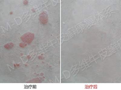 治疗牛皮癣疾病的常用偏方