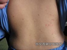 钱币状牛皮鲜症状是什么