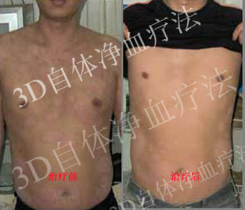 治疗儿童牛皮癣要注意什么