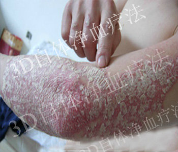 关节型银屑病有哪些护理方法