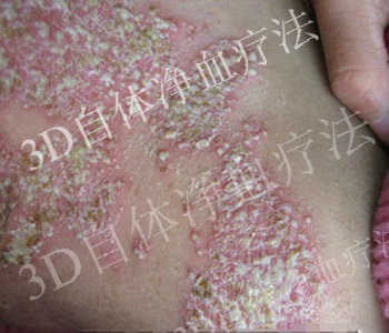 牛皮癣的种类
