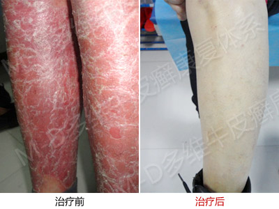 牛皮癣患者禁忌吃什么