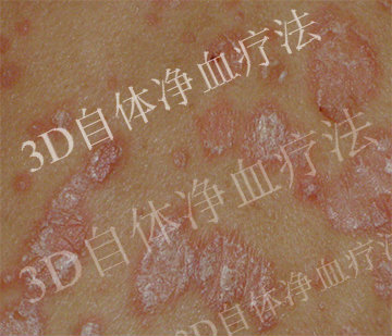 怎么诊断寻常型牛皮癣