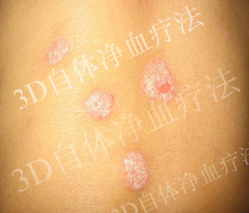 预防寻常型牛皮癣的方法有哪些