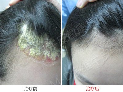 郑州市银屑病研究所 郑州市银屑病研究所