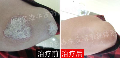 郑州市银屑病研究所 郑州市银屑病研究所