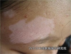 牛皮癣常发作的部位是哪些地方 牛皮癣常发作的部位是哪些地方