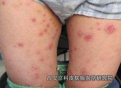 关节型银屑病的症状 关节型银屑病的症状