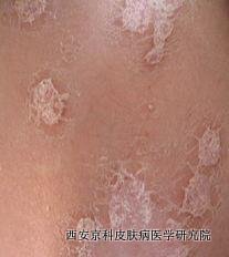牛皮癣有哪些症状 牛皮癣有哪些症状