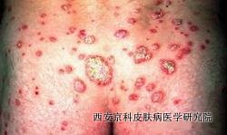 脓包型银屑病症状 脓包型银屑病症状