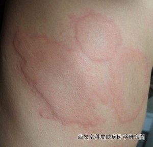 您了解银屑病吗 您了解银屑病吗
