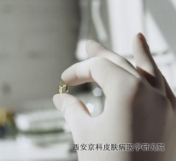 哪些因素引来牛皮癣