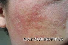您了解寻常型银屑病吗 您了解寻常型银屑病吗