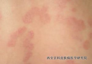 牛皮癣早期 牛皮癣早期
