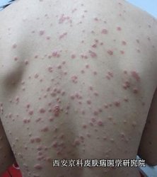 哪些是牛皮癣症状 哪些是牛皮癣症状