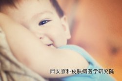 儿童患上牛皮癣的原因 儿童患上牛皮癣的原因