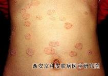 哪些疾病与牛皮癣病相似 哪些疾病与牛皮癣病相似