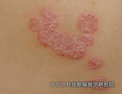 初期牛皮癣症状是什么 初期牛皮癣症状是什么