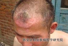 头部牛皮癣有什么症状 头部牛皮癣有什么症状