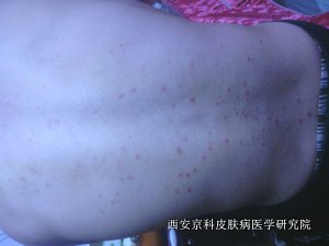 牛皮癣症状是怎样的 牛皮癣症状是怎样的