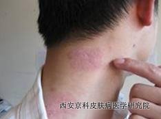 头上牛皮癣怎么护理它 头上牛皮癣怎么护理它
