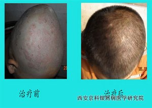 头部牛皮癣应怎么治疗 头部牛皮癣应怎么治疗