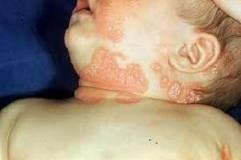 儿童牛皮癣治疗应避免哪些药物 儿童牛皮癣治疗应避免哪些药物