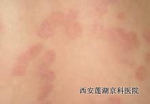 初期牛皮癣是怎样的 初期牛皮癣是怎样的