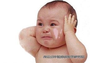儿童牛皮癣要怎么治疗好呢 儿童牛皮癣要怎么治疗好呢