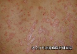 牛皮癣有怎样的症状 牛皮癣有怎样的症状