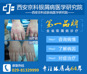 郑州治疗牛皮癣技术好的医院