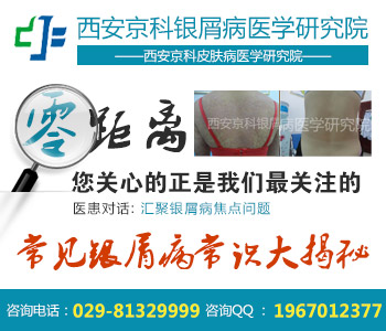 郑州最好银屑病专科医院 郑州最好银屑病专科医院