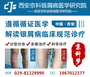 河南哪家医院治银屑病好 河南哪家医院治银屑病好