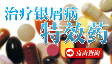 什么药治牛皮癣最好 什么药治牛皮癣最好