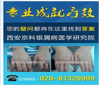 河南哪边治疗牛皮癣较好 河南哪边治疗牛皮癣较好