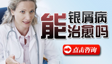 如何科学治疗牛皮癣 如何科学治疗牛皮癣