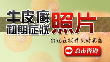 牛皮癣图片 牛皮癣图片