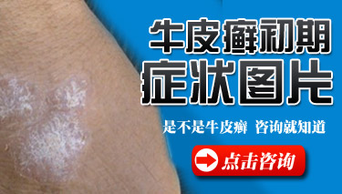 牛皮癣的初期图片 牛皮癣的初期图片