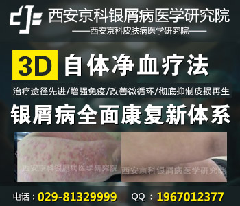 榆林治疗银屑病哪家医院好 榆林治疗银屑病哪家医院好
