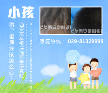 冬季青少年牛皮癣怎么预防呢 冬季青少年牛皮癣怎么预防呢