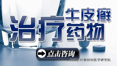 治疗牛皮癣的药物 治疗牛皮癣的药物