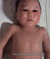 儿童牛皮癣 儿童牛皮癣