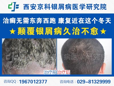 郑州哪个医院治疗牛皮癣好 郑州哪个医院治疗牛皮癣好