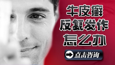 牛皮癣复发应该怎么办 牛皮癣复发应该怎么办