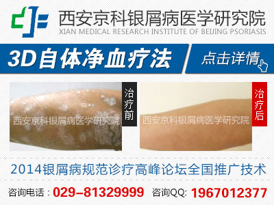 河南哪家医院看银屑病好 河南哪家医院看银屑病好
