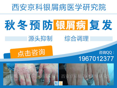 冬季,小心银屑病病情加重 冬季,小心银屑病病情加重