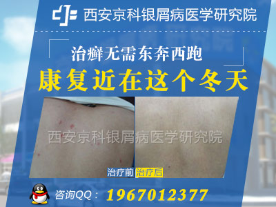 冬季牛皮癣患者如何减少瘙痒症状 冬季牛皮癣患者如何减少瘙痒症状